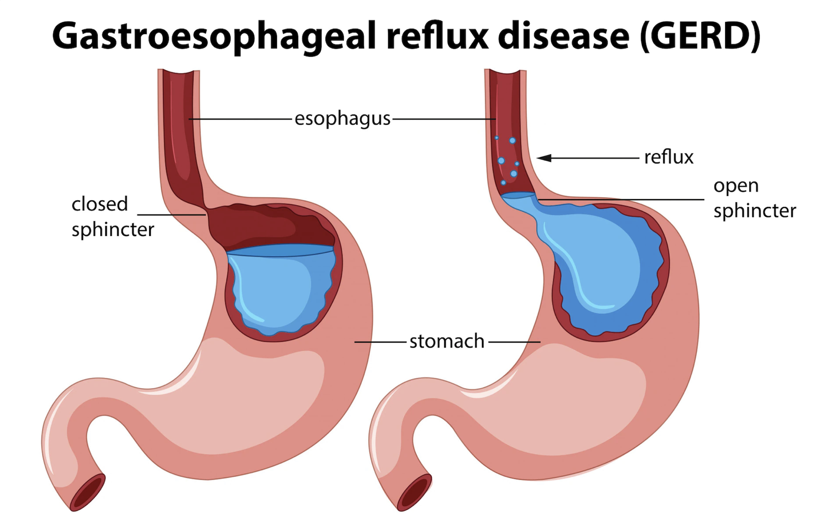 can-gerd-cause-voice-changes